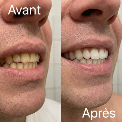 Vioren - Bandes blanchissantes violettes pour les dents